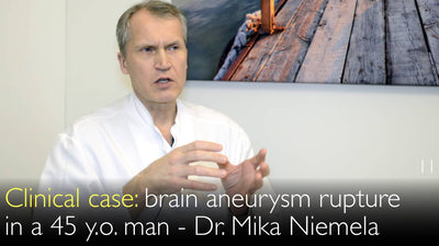 Brain aneurysm rupture in a 45 year-old man. Clinical case. 11